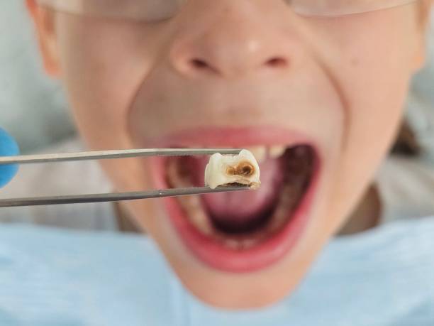 Best Emergency Wisdom Teeth Removal in Baker, LA